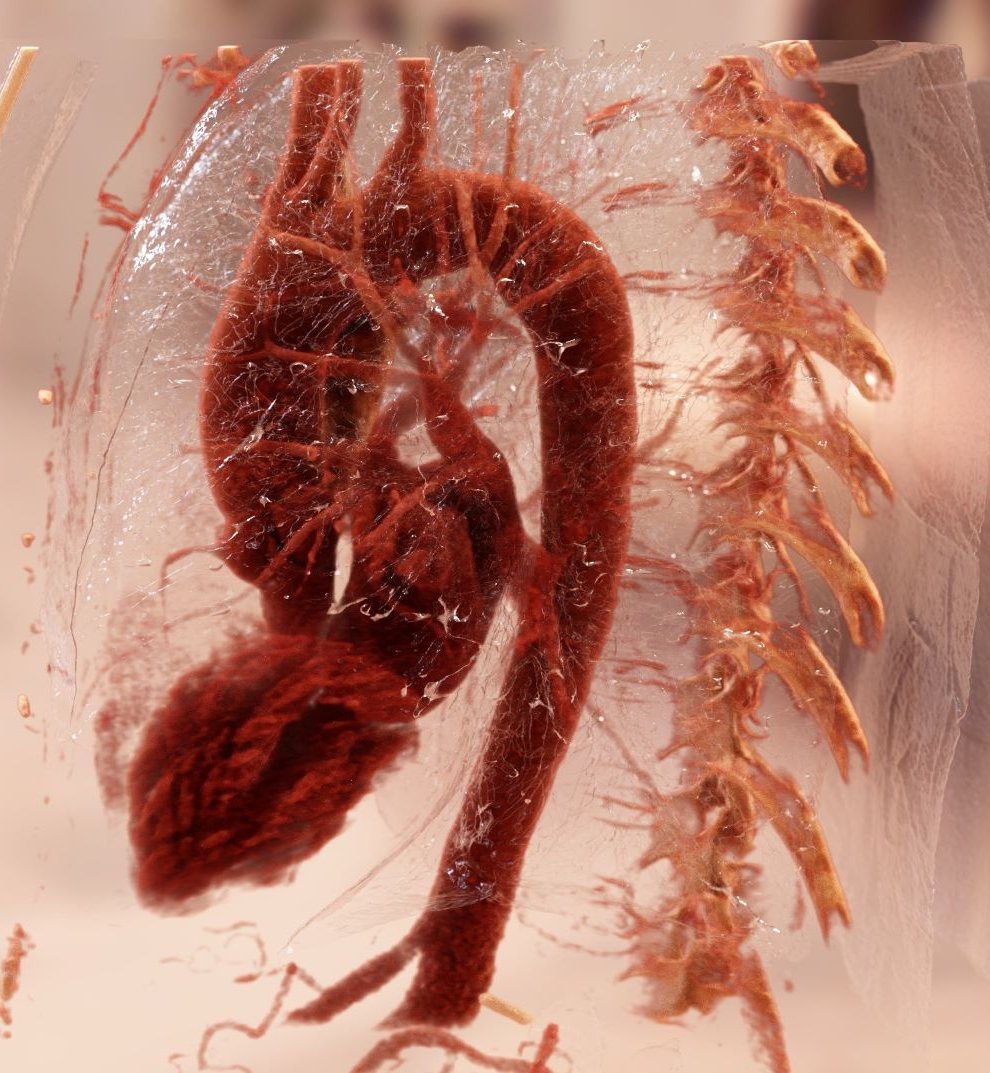A cardiac scan showing the mesh of muscle fibres inside the heart