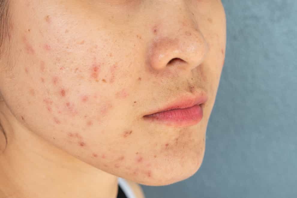 Close-up of woman half face with problems of acne inflammation (Papule and Pustule) on her face.