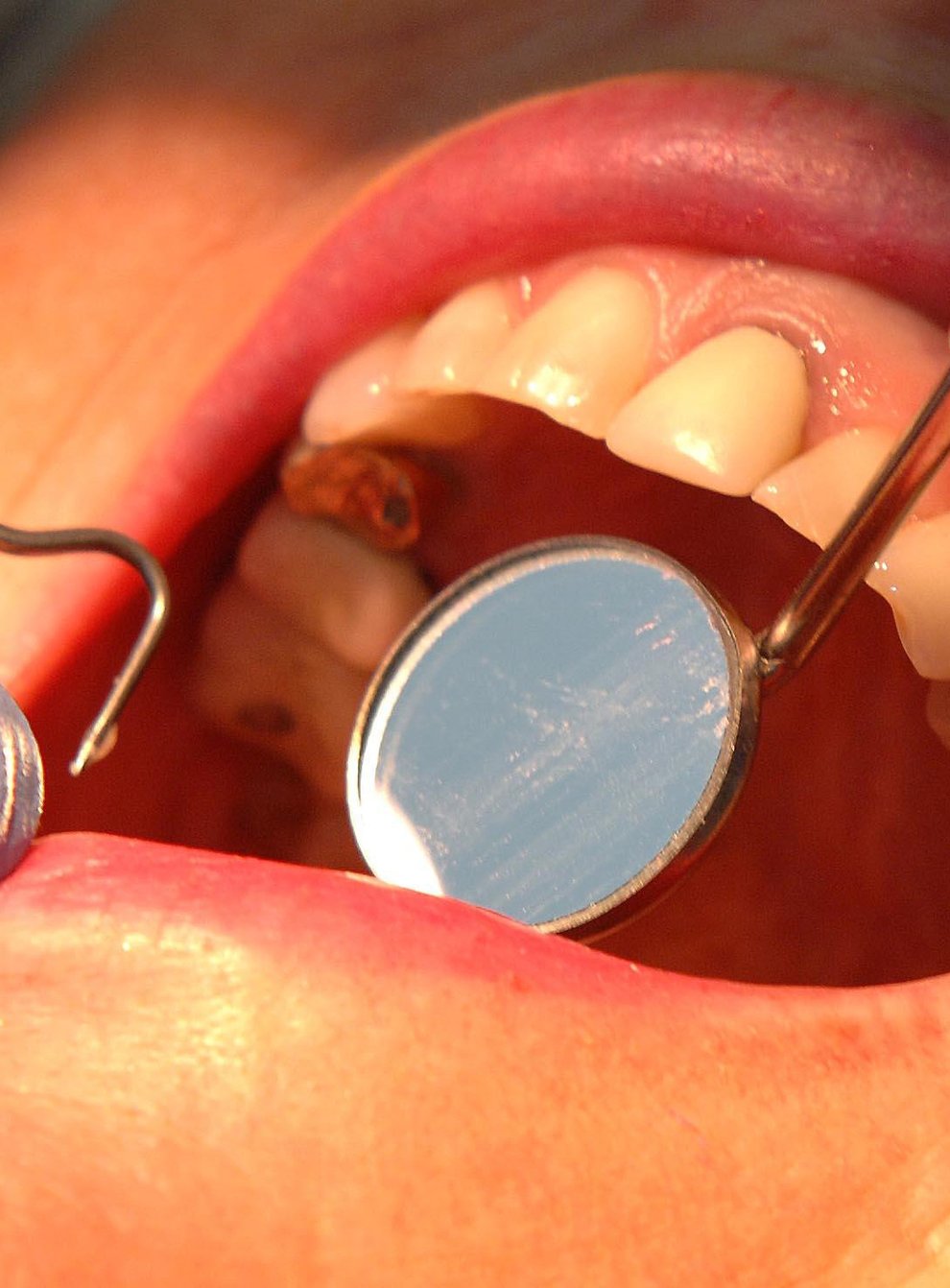 A dentist examining a mouth