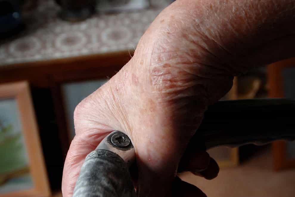 The swollen wrist of a rheumatoid arthritis sufferer
