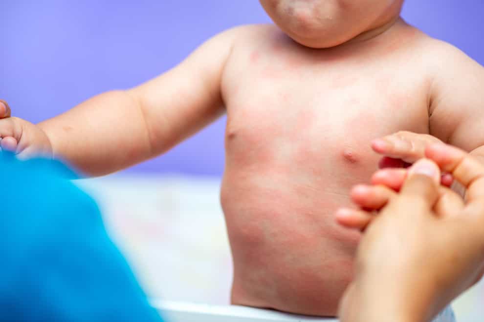 Baby with a skin rash (Alamy/PA)