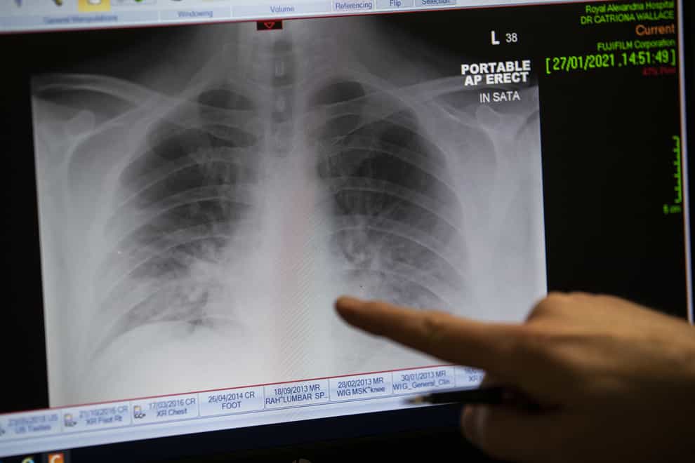 Researchers uncover a gene that doubles the risk of respiratory failure from Covid-19 (Jane Barlow/PA)