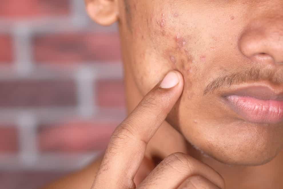 Don’t believe these oft-repeated acne myths (Alamy/PA)