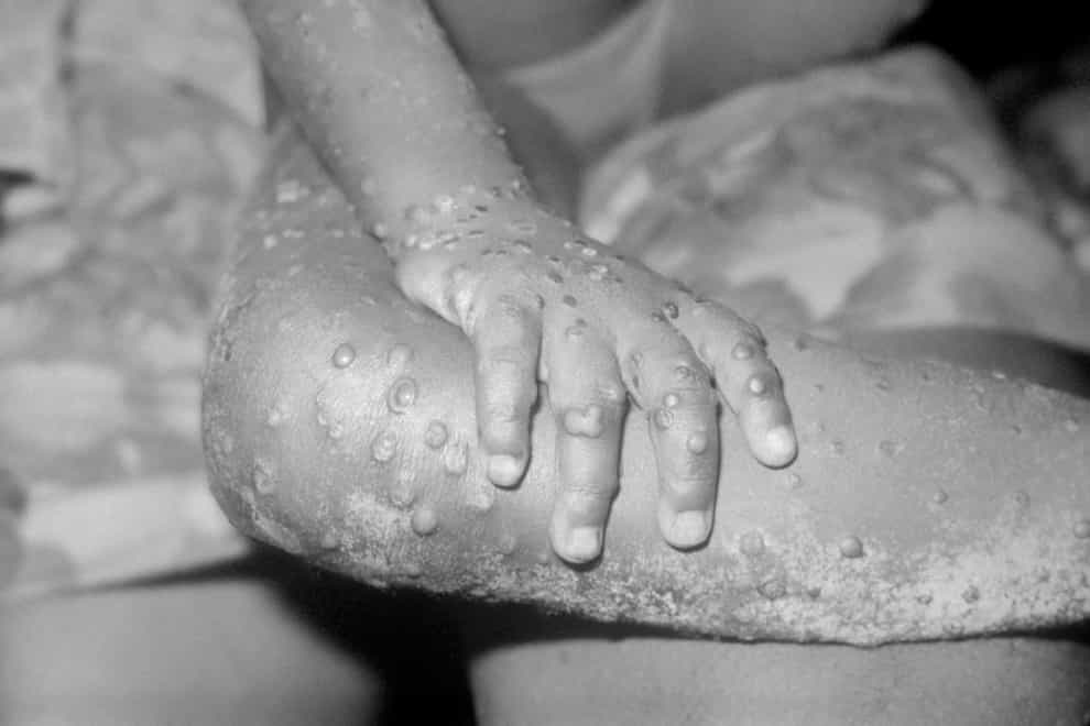 Experts have identified nine cases of Monkeypox in the UK. Alamy/PA.