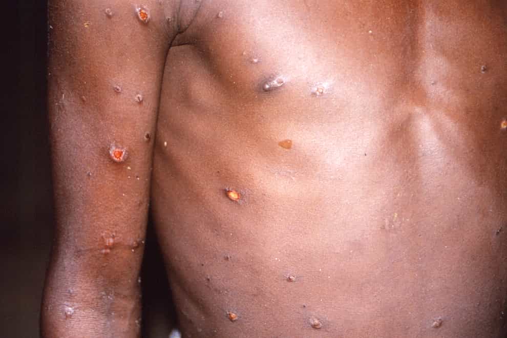The right arm and torso of a patient with lesions due to monkeypox (CDC/AP)