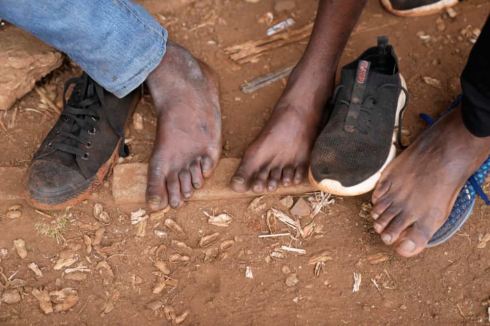 Street vendors take off their shoes to show their toes on the streets of Harare, Zimbabwe (Tsvangirayi Mukwazhi/AP)