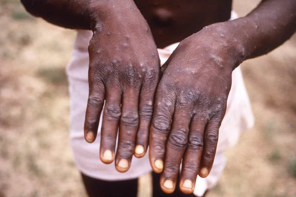 The hands of a monkeypox patient (CDC/AP)