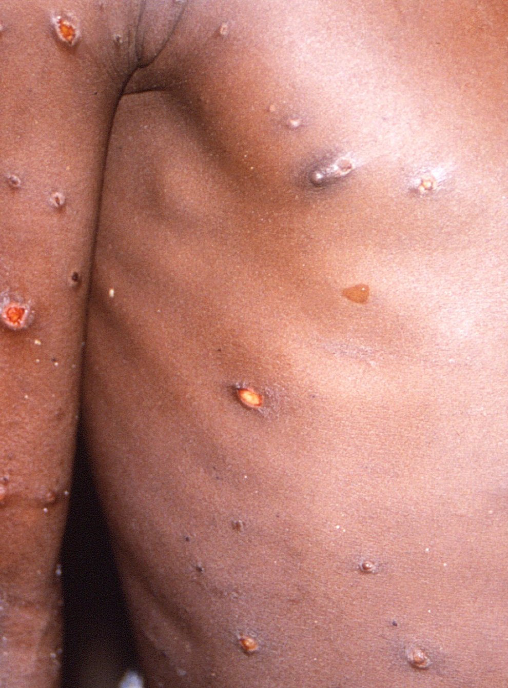 The monkeypox outbreak may be slowing, figures suggest (Brian W.J. Mahy/PA)