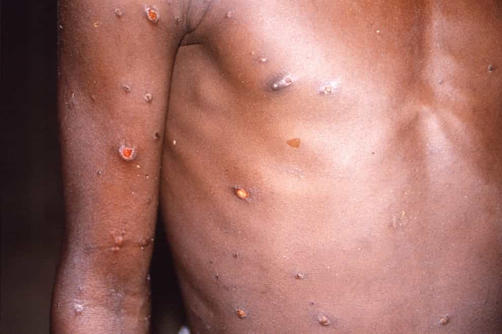 Global health experts are to rename monkeypox after “racism and stigmatising language” emerged following the latest outbreak (Brian WJ Mahy/PA)