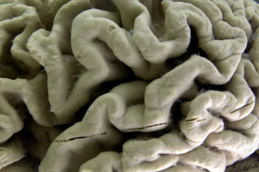 A human brain affected by Alzheimer’s disease (AP)