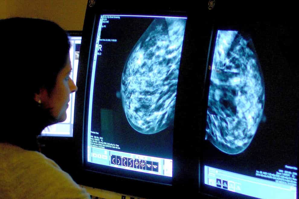 Scientists discover a new way to help prevent breast cancer ‘time bomb’ (Rui Vieira/PA)