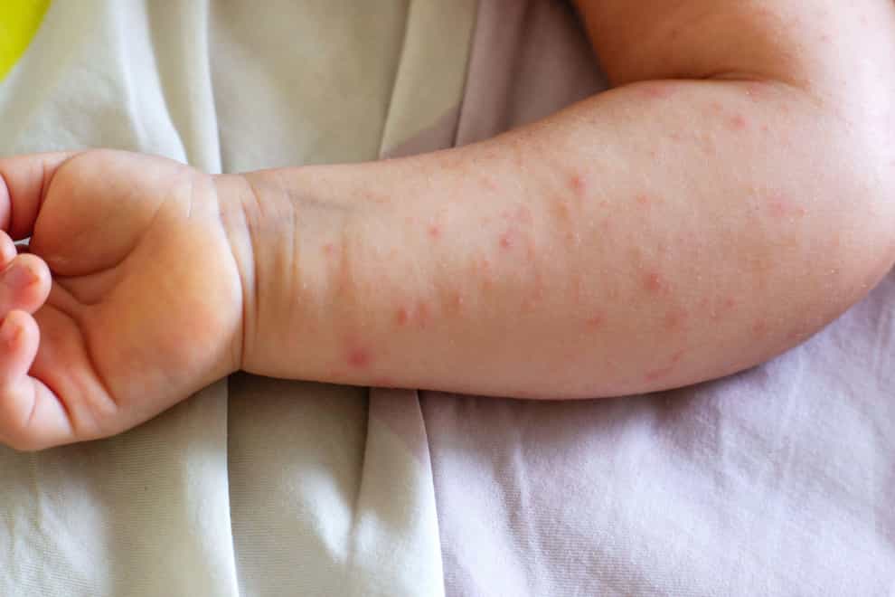 The new Nice draft guideline – on the diagnosis and management of atopic eczema in children under 12 – is now subject to public consultation (Alamy/PA)