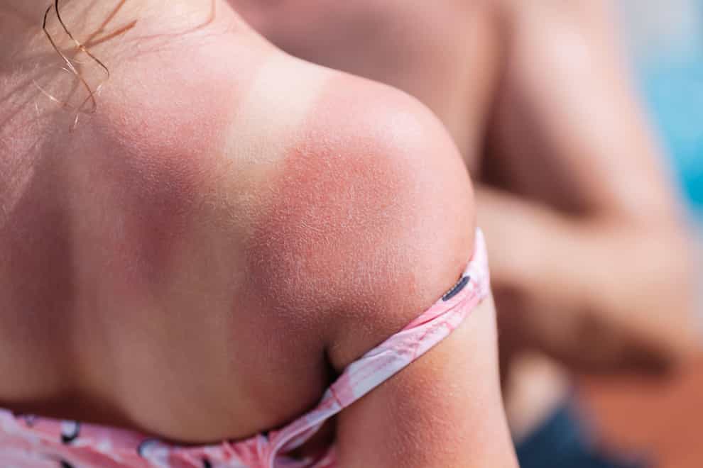 Even one instance of sunburn can cause significant damage (Alamy/PA)