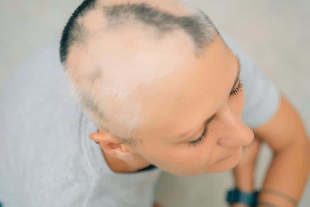 Around 14,000 people with alopecia areata are expected to benefit from the Nice decision (Alamy/PA)